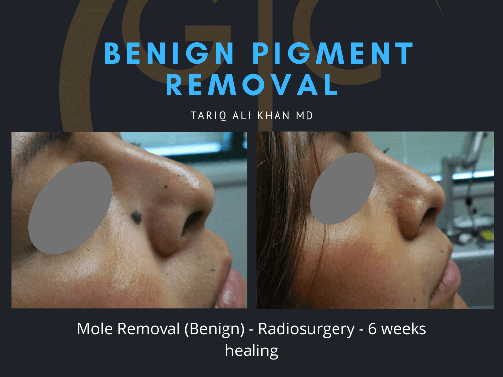 Gentle Care Laser Tustin Before and After picture - Mole Removal